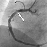 What is Angiogram?