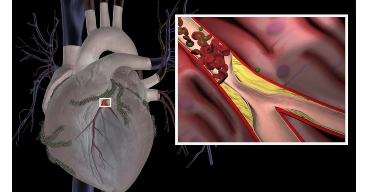 Coronery Artery Disease