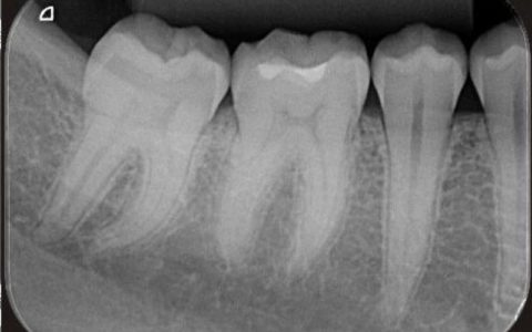 Intraoral Periapical Radiograph (IOPA)